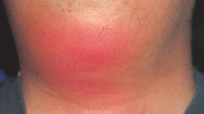 蜂窩織炎の症状　顔の写真